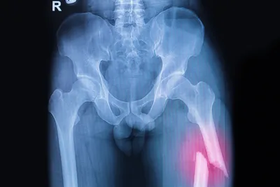 Life-altering truck accident injuries